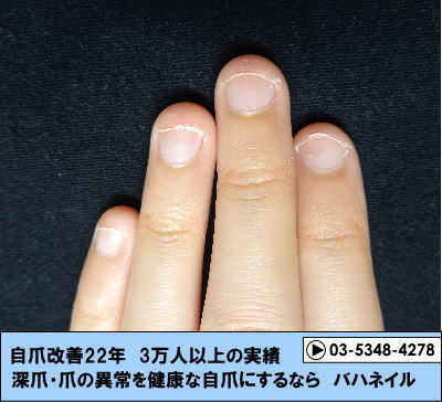 カイナメソッドによる深爪自立矯正で爪が横長から縦長へ変化　爪をいじる癖も解決