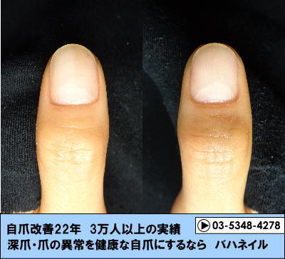 親指の爪ボコボコ変化画像