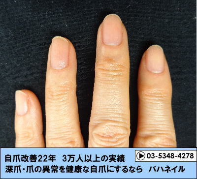 指先の爪が剥がれてくる症状（剥離）