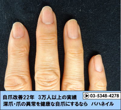 指先の爪が剥がれてくる症状（剥離）