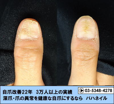 親指の爪の真ん中がへこんでいる症状
