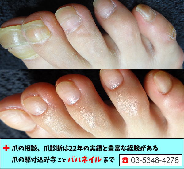 足の親指の爪が変形