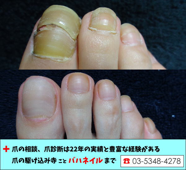 足の親指の爪が変形