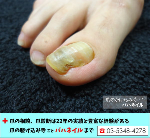 足の親指の厚み（爪甲鉤弯症）