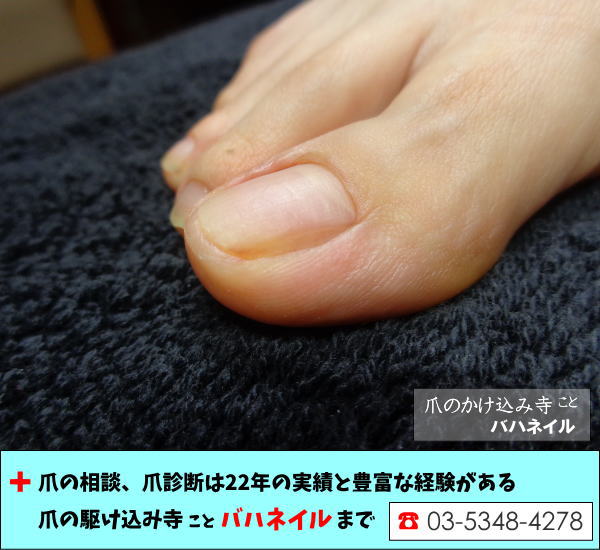 足の親指の厚み（爪甲鉤弯症）