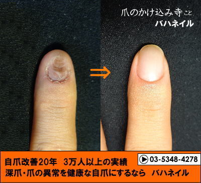 男性のゲスト 爪をむしる 深爪矯正の変化画像 病院で治らなかった爪の病気も健康的な爪に治すブログ